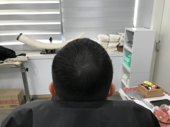 시술후