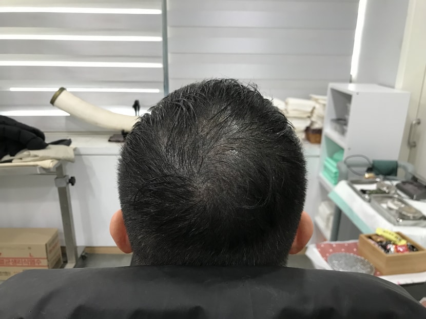 시술전 젖은머리
