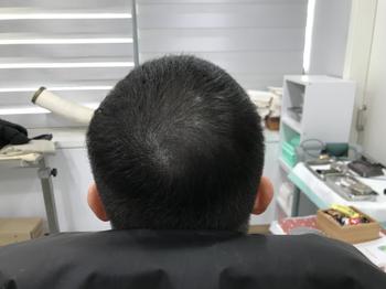 시술전