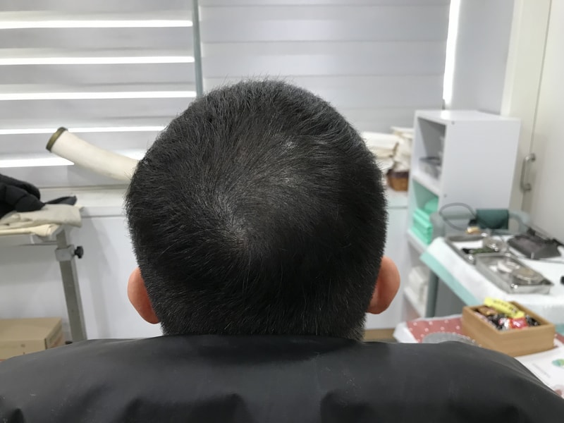 头顶头皮纹身1次补强后记。"