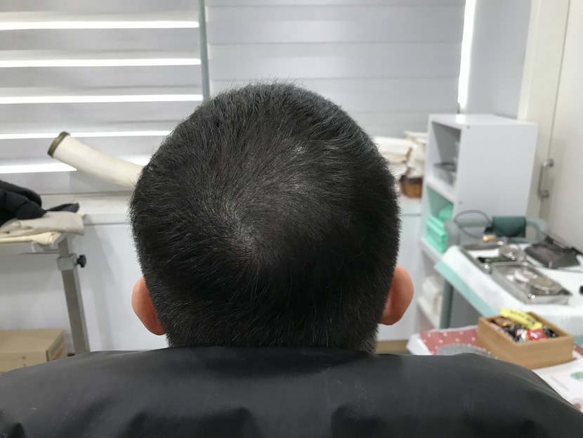 시술전