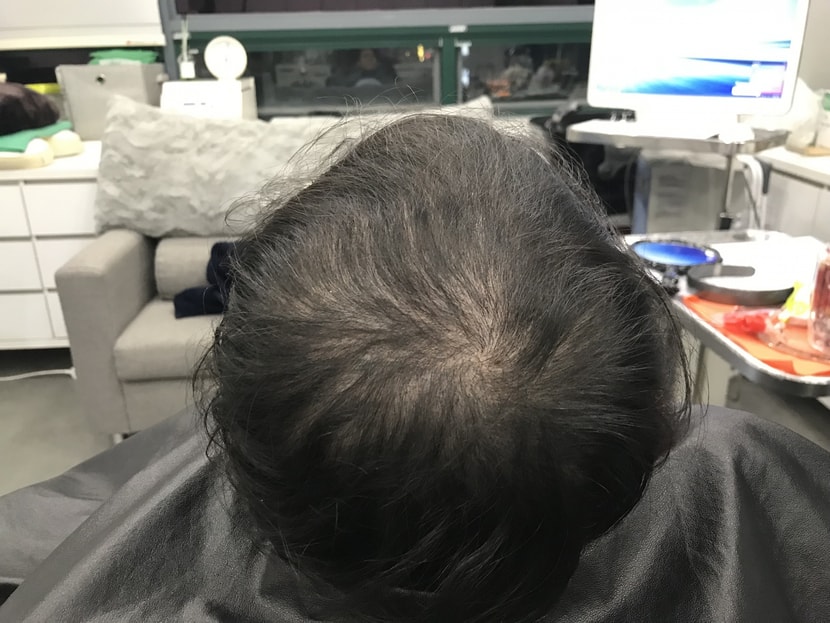 보강전