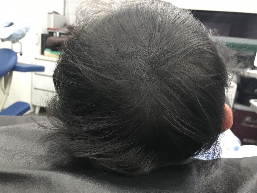 보강후