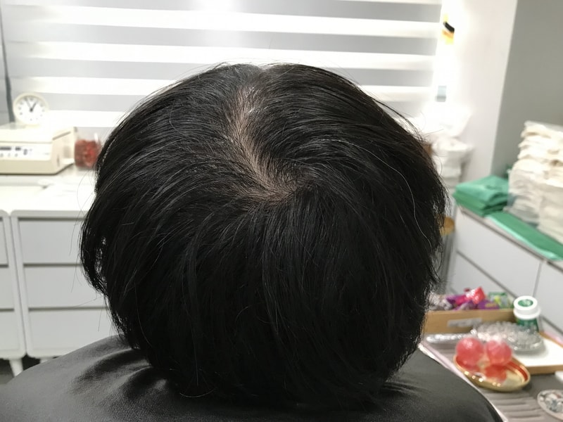 スジチム微細ドットタトゥー体験談です