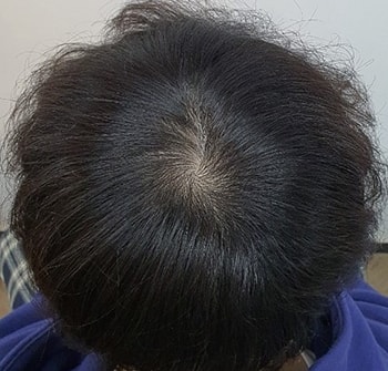 ハンナイブから頭皮を刺されました。