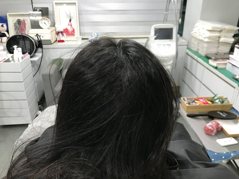 시술후 머리