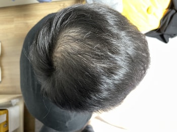 시술전