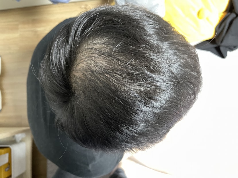 시술전
