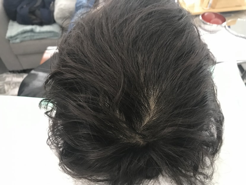 시술전 마른 상태 2