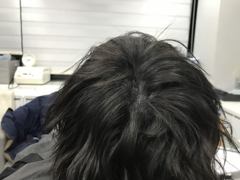 시술 후 살짝 젖은 상태