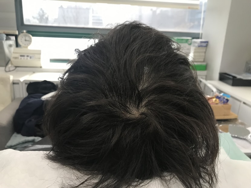 시술전 마른 상태1