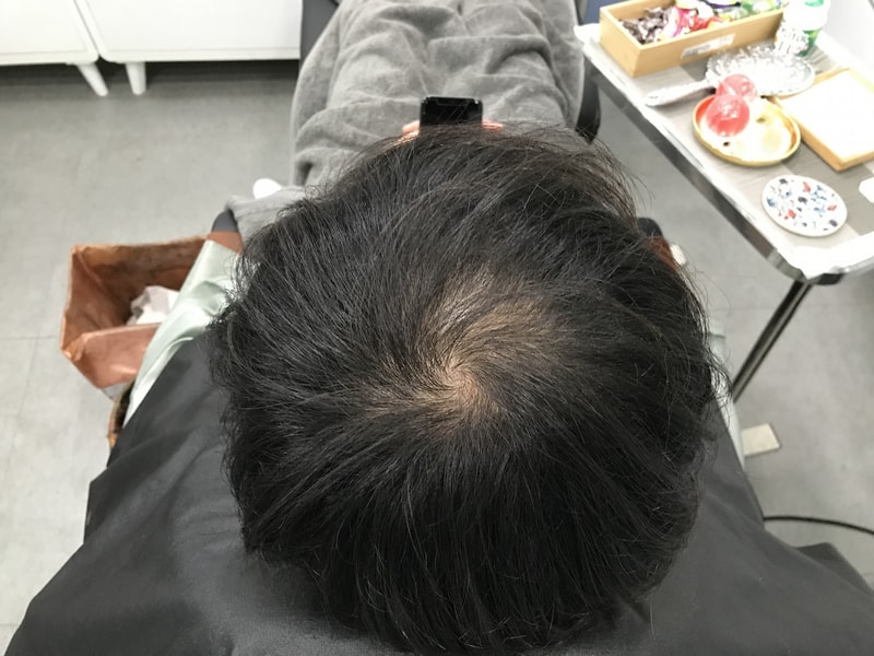 头皮纹身留下后记