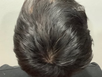 최근 정수리 상태