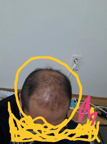 엠자정수리1회이식