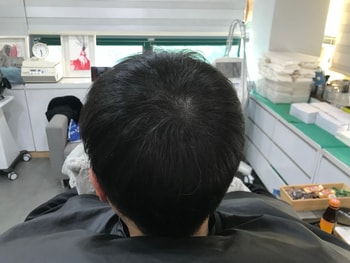 시술후