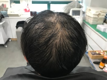 시술전 젖은머리