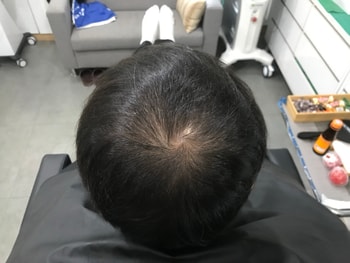 시술전2