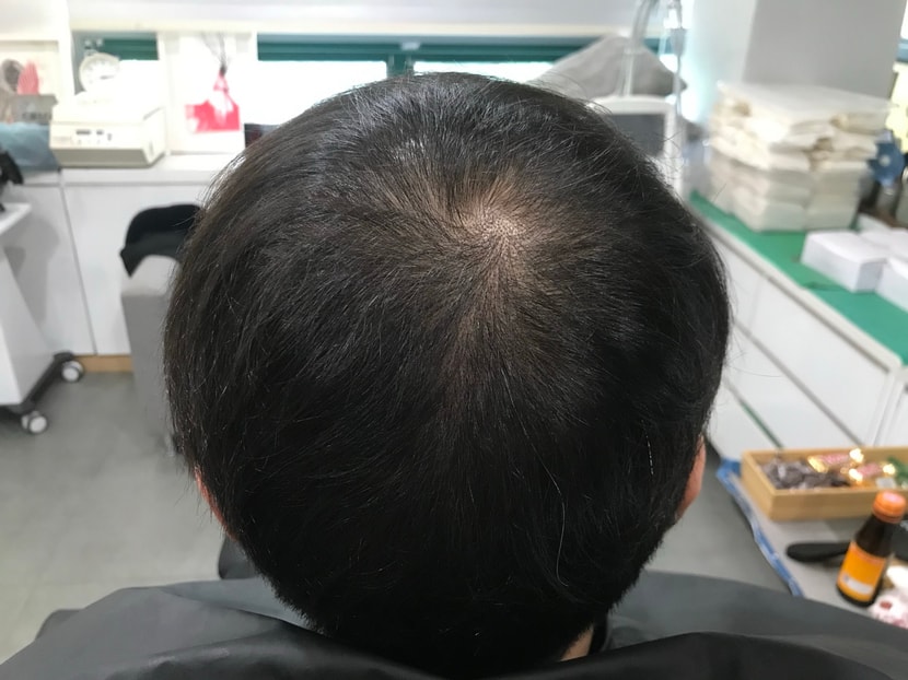 시술전1