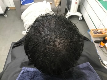 시술후 젖은머리
