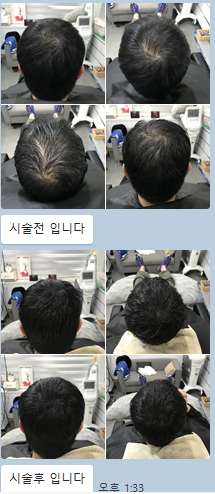 두피문신 전후
