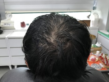 시술전 젖은머리