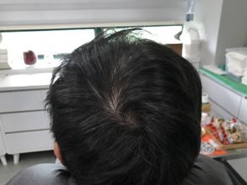 시술전 마른머리