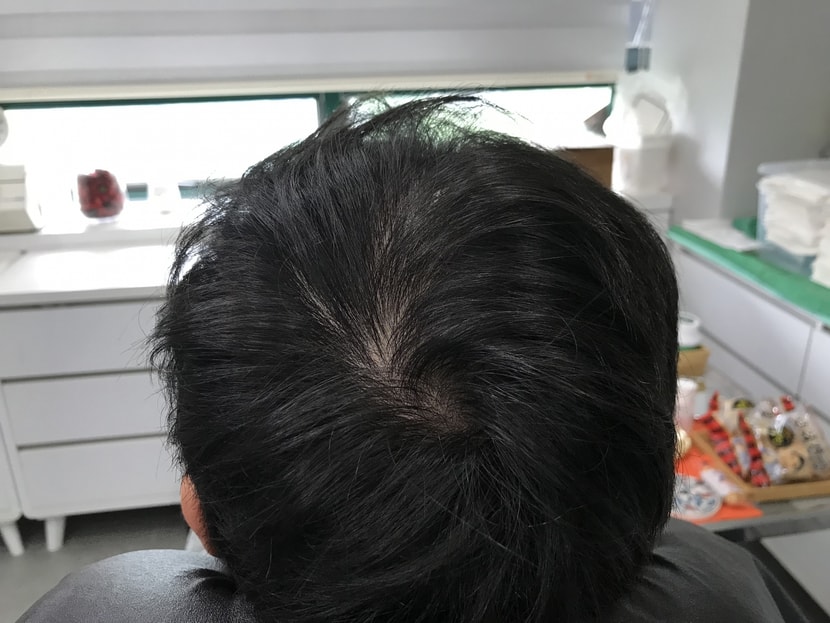 시술전 마른머리