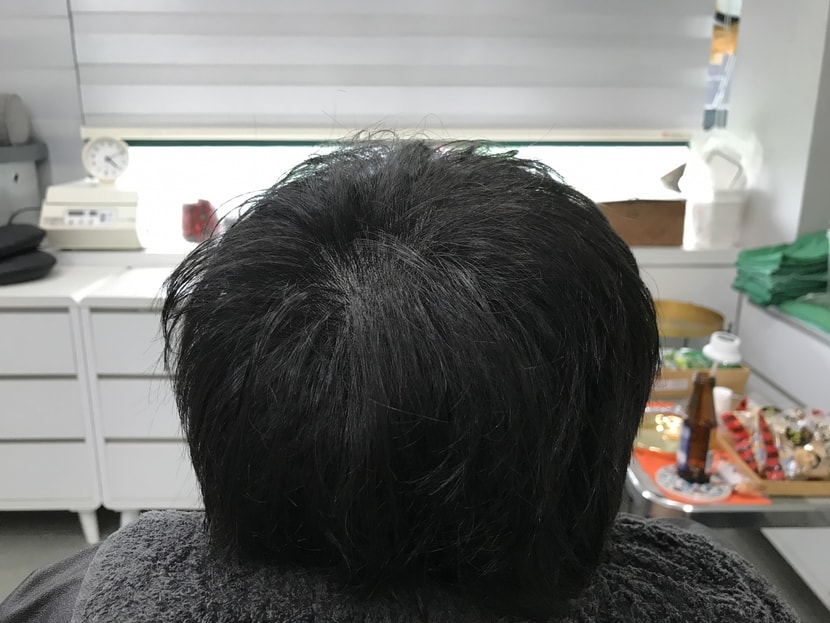 시술후 마른머리-1