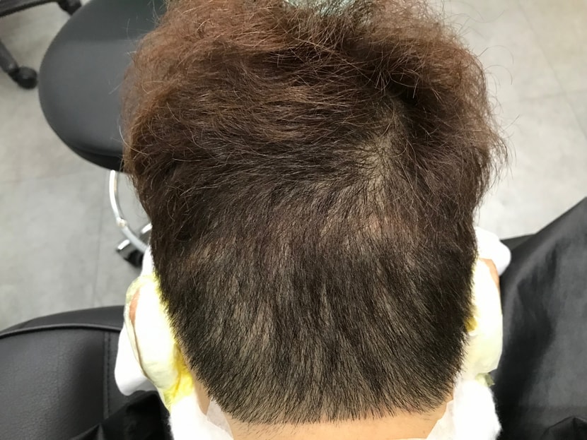 시술전