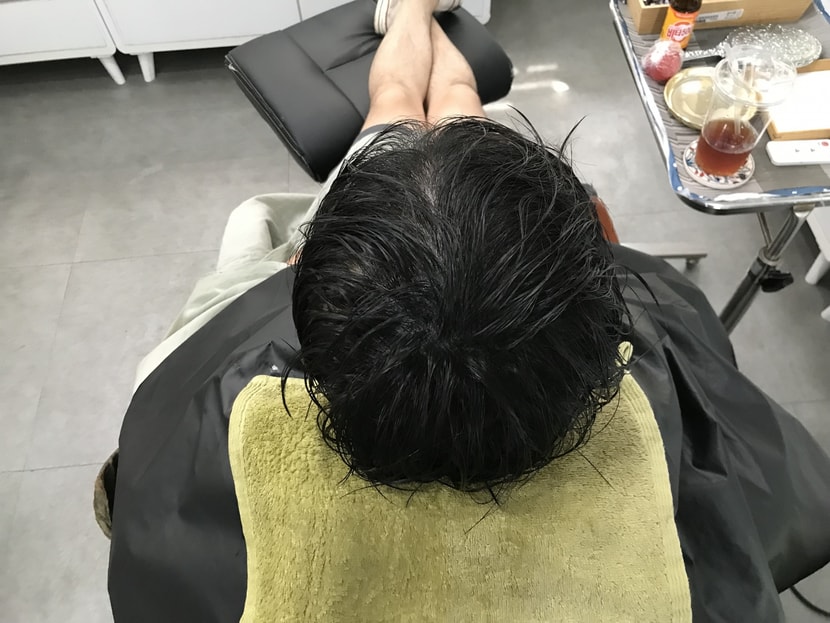 2차시술 후