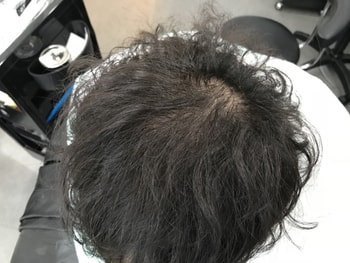 시술 전