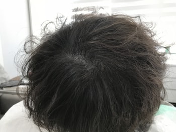 2차 시술 후