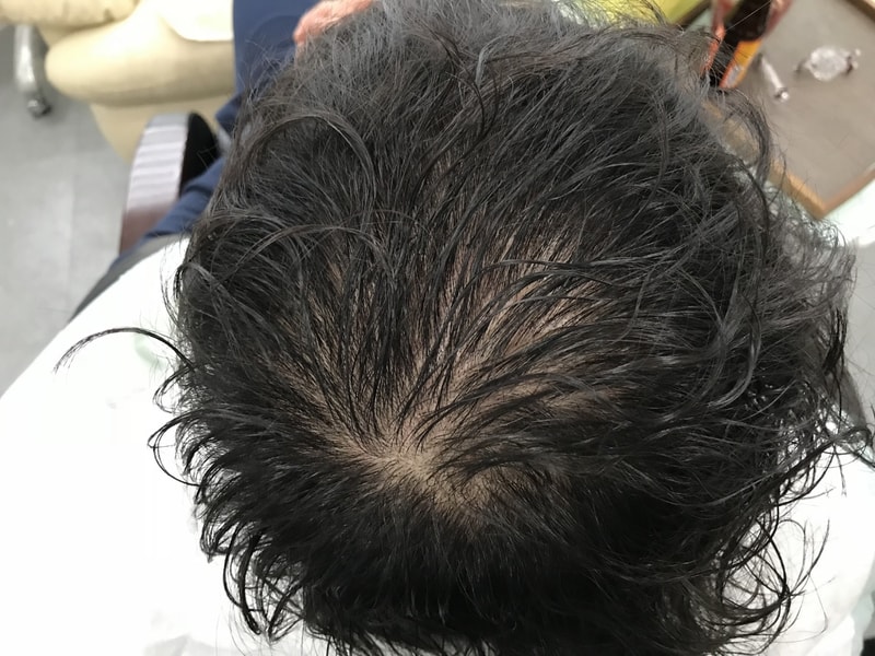 手术前后，2次手术（修复）前后