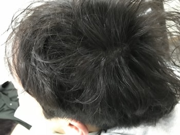 시술 후