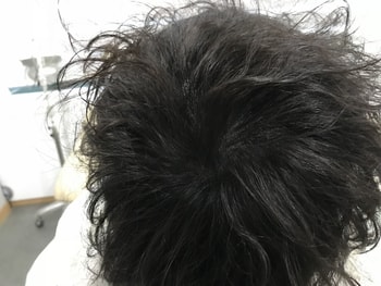시술 후