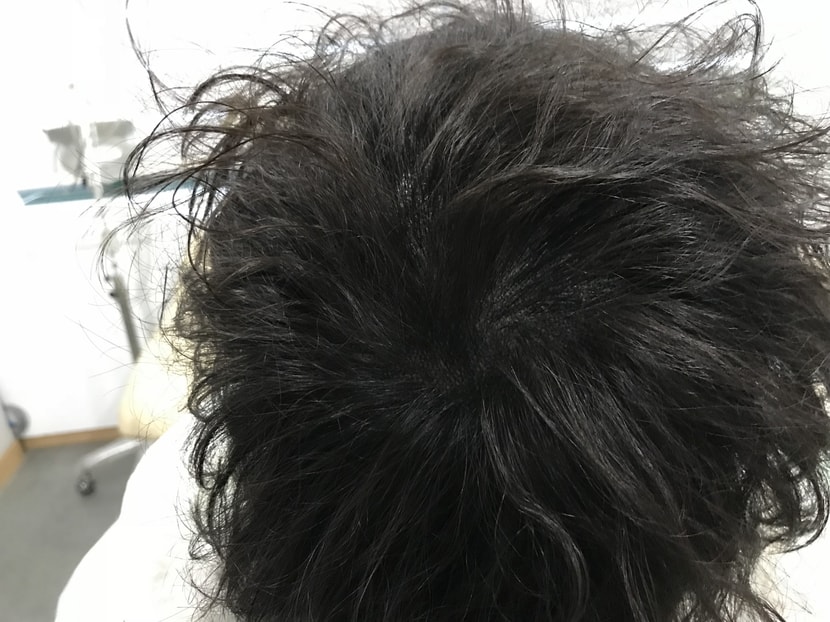 시술 후
