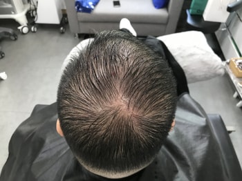 시술 전1