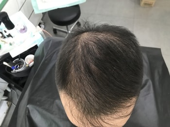 시술 전2