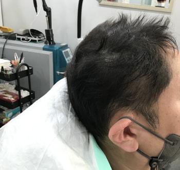 시술후