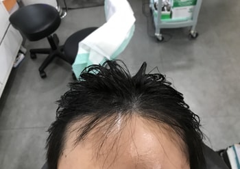 시술후 사진입니다 (확실히 전후가 다릅니다)