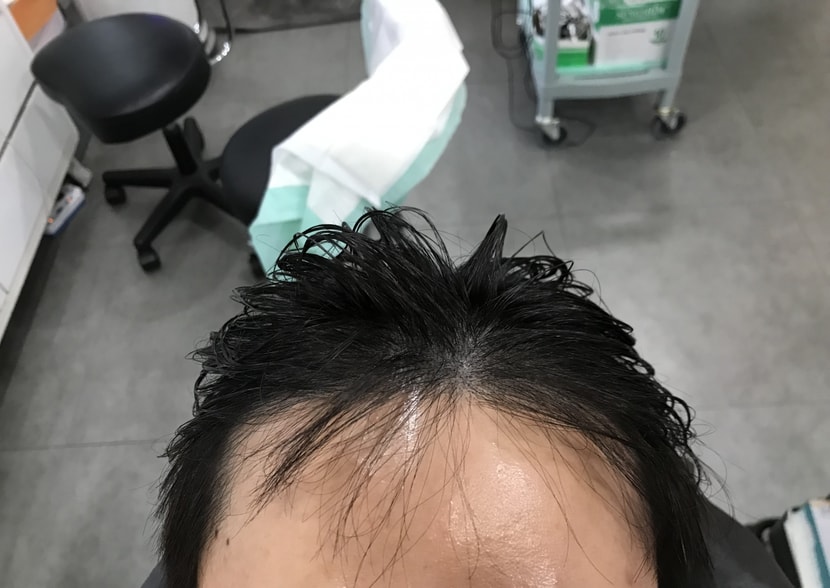 시술후 사진입니다 (확실히 전후가 다릅니다)