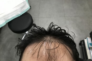 시술전 사진입니다 (밀도가 떨어저 보이네요)