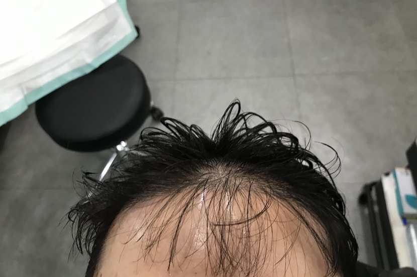 시술전 사진입니다 (밀도가 떨어저 보이네요)