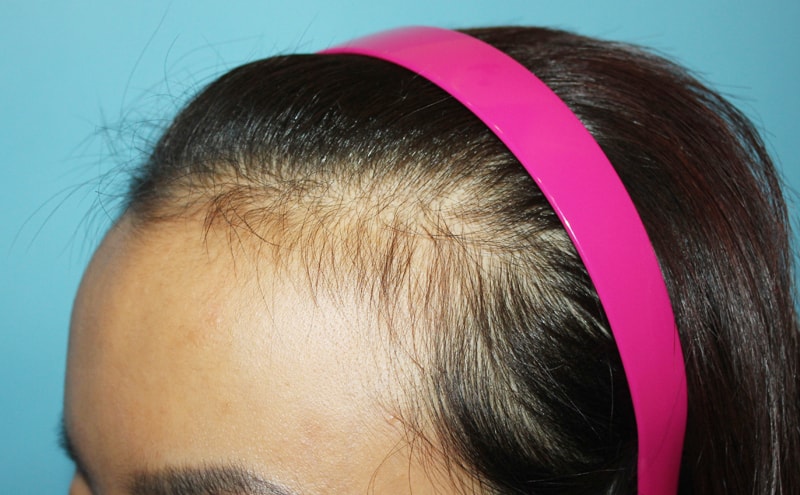 여자 헤어라인 반영구 후기는 별로 없는것 같아서..