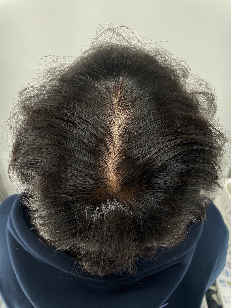 上传头皮纹身后记！ 在江南NEWHAiR 植发中心漂亮地接受头皮纹身吧 bb大满贯