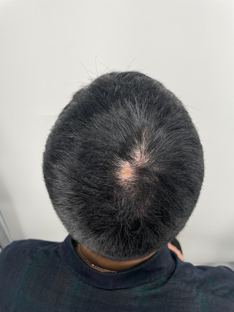 I covered the top of my head! It bothered me because I looked so white, but I'm happy that it came out well (Gangnam scalp tattoo)