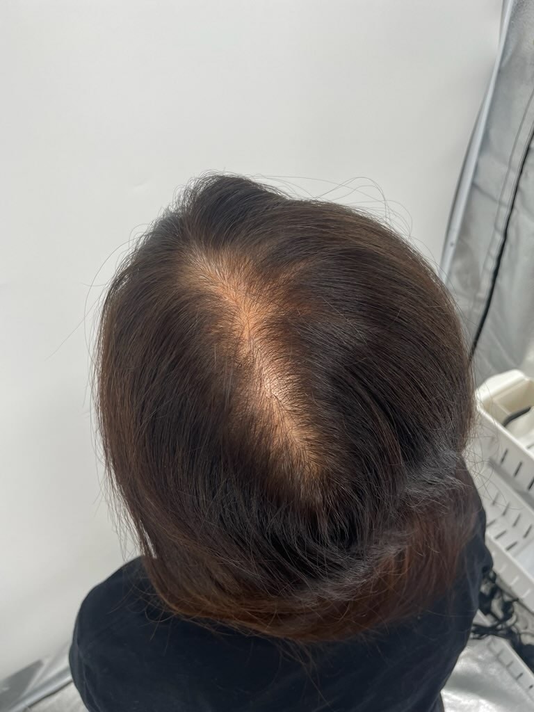 강남뉴헤어에서 두피문신 시술 받은사연 ♡(흡족)