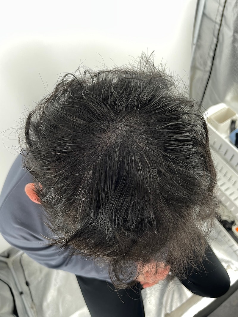 강남 뉴헤어 두피문신 받았어요. 완전 좋네요!