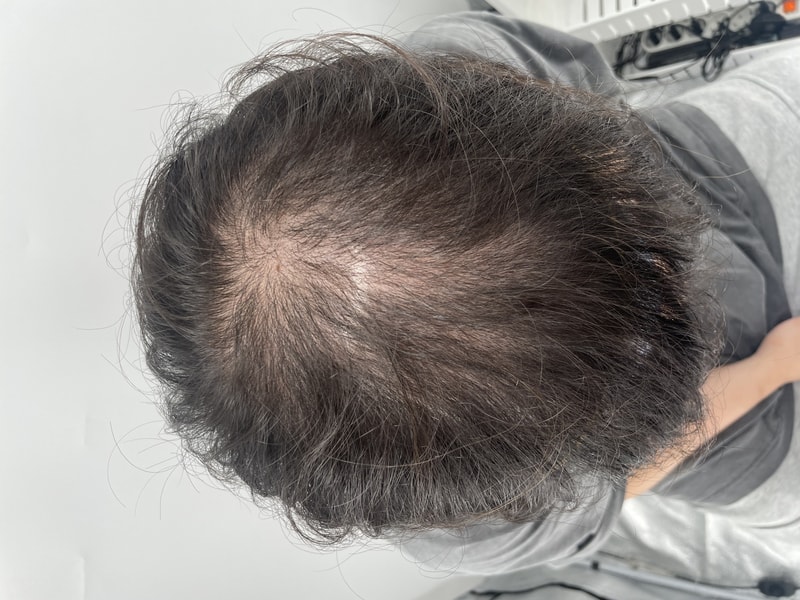 (NEWHAiR 植发中心)我选择了20多岁的头皮纹身！ 手术非常细致，满意度非常高（NEWHAiR 植发中心头皮纹身医院后期）