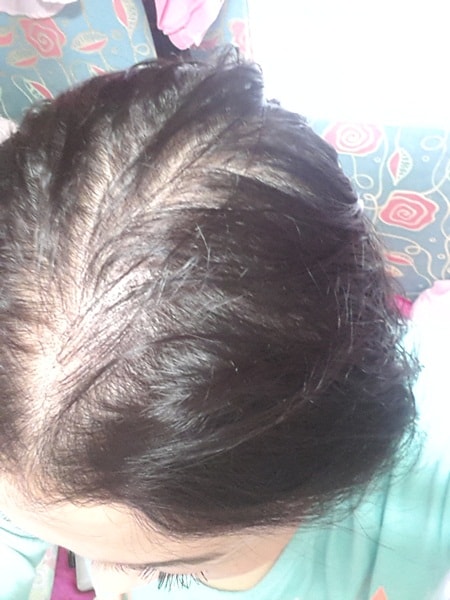 DMP 두피문신 리터치 후기요~(첫 시술 3개월 반 후)